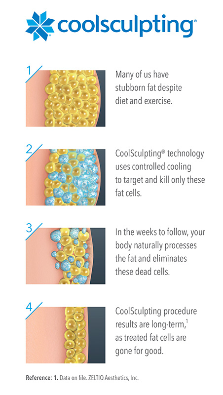coolsculpting fat reduction midtown manhattan NYC